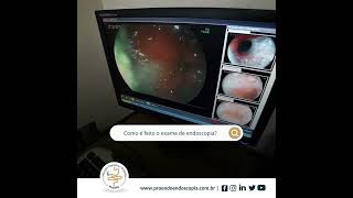 Como é feito o exame de endoscopia [upl. by Mathilda652]