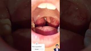 throat tonsils tonsillitis tonsil treatment গলার চিকিৎসা [upl. by Guinn]