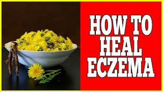 How To Heal Eczema  How To Heal Eczema With 1 Easy Method [upl. by Englebert]