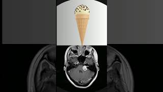 radiologyshortsvestibular schwannomasigns radiologysigns [upl. by Kisor]