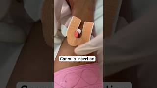 IV cannula preparation legMLTsolutions [upl. by Paff535]