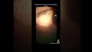 Scleral contact lens over a keratoconus cornea Keratoconus Sclerallens Cornealring CXL Intac [upl. by Burty]