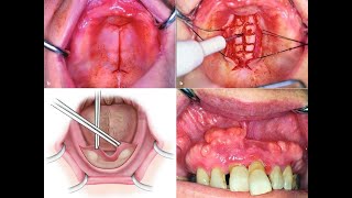 Preprosthetic Surgery 2 [upl. by Ferdinande]