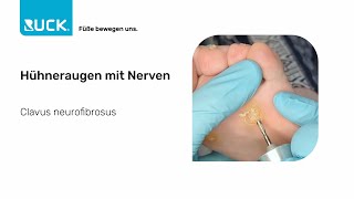 Behandlung von Hühneraugen mit Nerven Die Top Tipps [upl. by Drarig503]