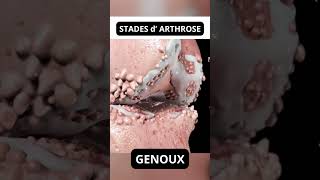 STADES ARTHROSE genoux chondropathie GENOU et CHONDROPATHIE douleurgenou genou arthrose [upl. by Airol]