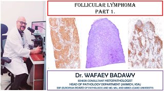 FOLLICULAR LYMPHOMA PART1 BY DR WAFAEY BADAWY [upl. by Norwood]