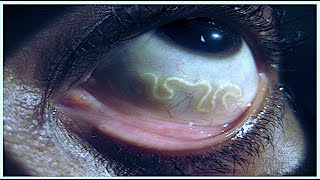 The Worms That Can Crawl Under Your Skin Zoonotic hookworm [upl. by Lezti]