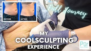 My COOLSCULPTING EXPERIENCE  Full Journey  COOLSCULPTING BEFORE AND AFTER Photos  Pūr Skin Clinic [upl. by Ydualc352]