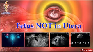 Fetus NOT in Utero [upl. by Elburr]