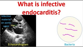 What is infective endocarditis [upl. by Anallise]