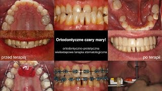 Ortodontycznoprotetyczna wieloetapowa terapia stomatologiczna [upl. by Eninnej217]