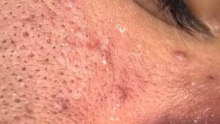 how to remove forehead pimples in one day  white blackheads on face  comedones treatment [upl. by Puritan]