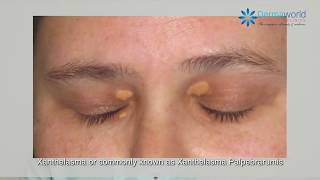 What is Xanthelasma   Dr Rohit Batra explains [upl. by Pandora]