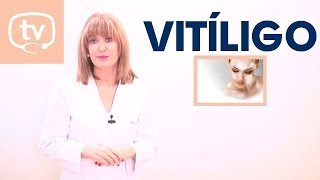 Causas síntomas y tratamientos del vitíligo [upl. by Winfield]