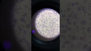 Severe microcytic hypochromic anemia patients slide microscopey [upl. by Ocsirf]