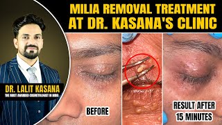 Milia Removal Treatment at DrKasanas Clinic  MILIA Removal Extraction  Before and after [upl. by Anilatak]