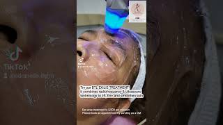 Effective nonsurgical eyebag removal and drooping eyelid treatment using BTL Exilis [upl. by Charline878]