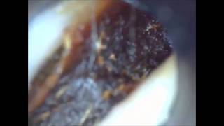 Ear Wax Removal Unbelievable collapsed ear canal [upl. by Naie]