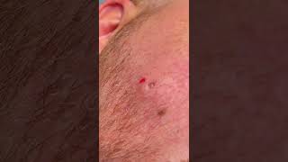 CHEEK CYST [upl. by Cristine705]