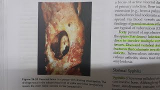 Osteomyelitis  SPECIAL PATHOLOGY [upl. by Naquin]