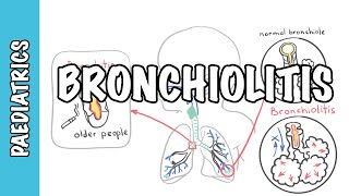 Bronchiolitis causes pathophysiology signs and symptoms treatment [upl. by Yrneh177]