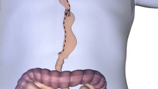 Esophagectomy Procedure Animation [upl. by Mraz]