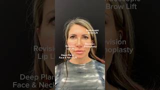 Facelift before and after browlift revisionrhinoplasty revisionfacelift liplift nycfacelift [upl. by Arocet376]