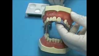 SuperBond CampB Direct Bonded Bridge using the Brushdip Technique [upl. by Suiradel]