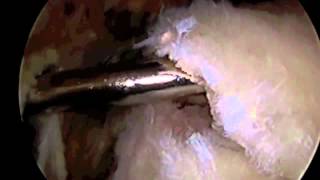 Arthroscopic Rotator Cuff Repair Surgery with SAD Dr Eric Janssen [upl. by Azeel]