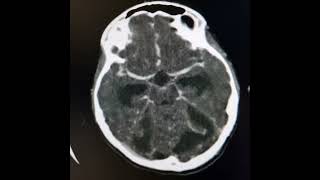 Otomastoiditis Sigmoid sinus thrombosis subdural empyema meningitis and obstructive hydrocephalus [upl. by Anoid386]