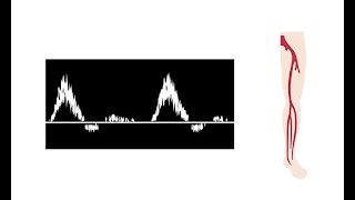 Interpreting duplex waveforms [upl. by Enilhtak]