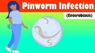 Pinworm Infection Enterobiasis  Causes Signs amp Symptoms Treatment [upl. by Alcinia]