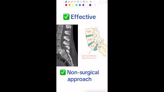 Diagnosis of the day  Spondylolisthesis [upl. by Shabbir630]