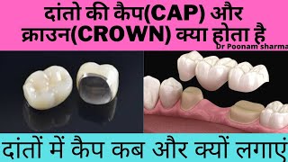 दांतों की कैपcapऔर क्राउनcrown क्या होता हैdental cap कब और क्यों लगाएं tooth capping and crown [upl. by Heid]