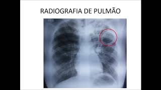 Curso de Radiologia de Tórax Aula V [upl. by Ariait]