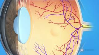 What is dry agerelated macular degeneration AMD [upl. by Kriss]