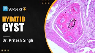 Hydatid Cyst  Surgery by Dr Pritesh Singh  PrepLadder NEETSS [upl. by Notsirk781]