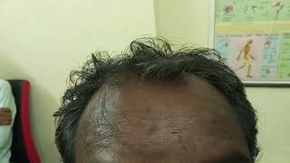 Hair loss Graying of hair Baldness Acne Allergy treatment [upl. by Nuawtna]