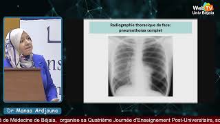 quotLe pneumothorax au bloc des urgences médicalesquot par Manaa Ardjouna MCB CHU Sétif [upl. by Ashli]