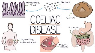 Understanding Coeliac Disease [upl. by Hewes]