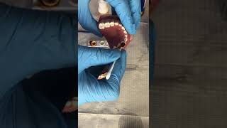 How to apply Povidone Iodine to teeth [upl. by Auqinat]