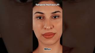 Temporal Mid Face Lift Surgery [upl. by Fleeta]