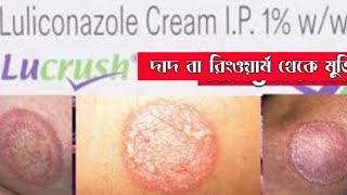 Ringworm treatment  দাদ  Luliconazole cream medinfobengali [upl. by Eirojam]