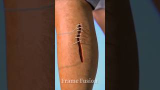 Understanding the Healing Process After Stitches  Frame Fusion [upl. by Ttocs]