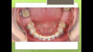 Orthodontics Treatment Before Dental Implants [upl. by Nosnah]