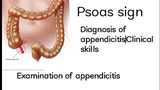 Psoas signExamination of appendicitisDiagnosis of appendicitisClinical skills appendicitis [upl. by Idnahs]