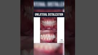 Ceramic Dental Braces Fixing Process  dentalbraces braces invisiblebraces orthodontictreatment [upl. by Adnil]