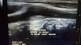 Échodoppler des TSA Sténose athéromateuse serrée [upl. by Aztinad]