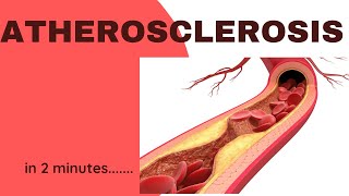 Atherosclerosis in 2 minutes [upl. by Lalise]