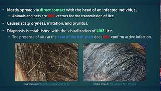 Head Lice [upl. by Anse]